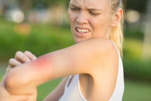 Treatment for Wasp Sting